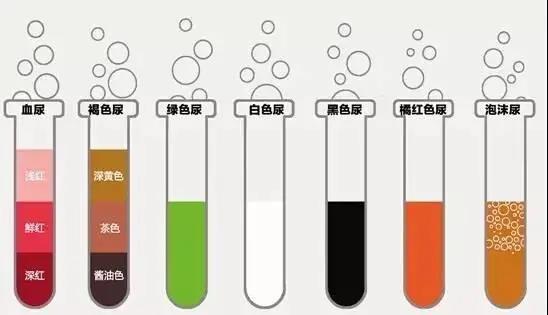 尿中有泡沫就是蛋白尿?教您如何"观尿液,辨肾病"